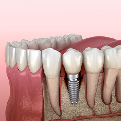 Dental implant illustration