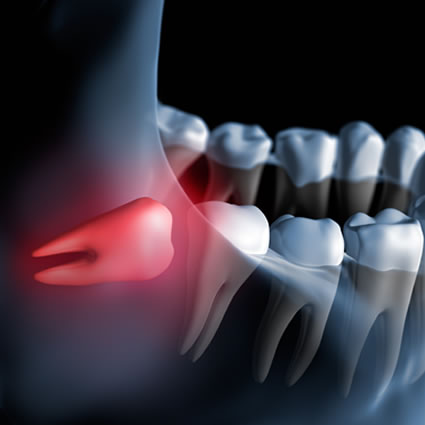 Impacted wisdom tooth xray