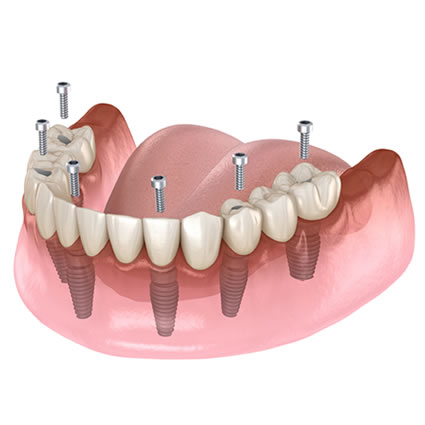 Implant bridge