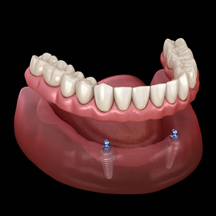 Implant supported dentures