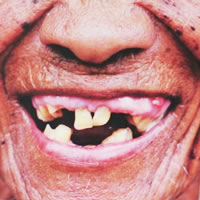 Old folk with gingivitis