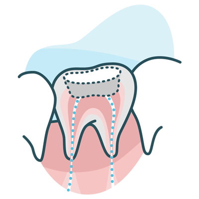 Dental root canal illustration