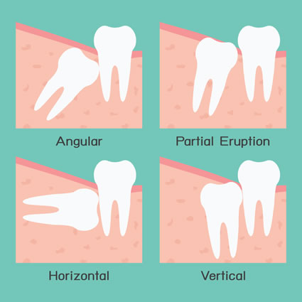 Types of impaction of wisdom teeth